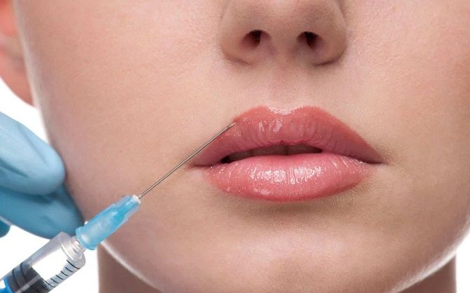 Контурная пластика губ с гиалуроновой кислотой: как безопасно увеличить губки и придать им красоту 2