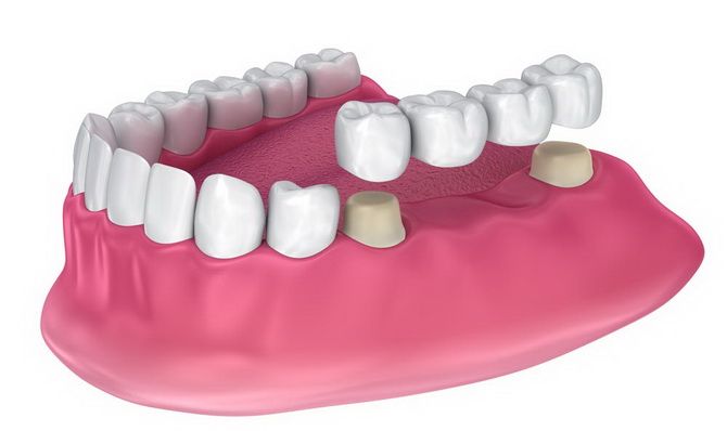 Чем заменить утраченный зуб — варианты протезирования 3