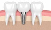 Чем заменить утраченный зуб — варианты протезирования