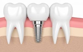 Чем заменить утраченный зуб — варианты протезирования