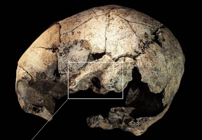 На черепе возрастом 5300 лет обнаружены следы древнейшей хирургической операции на ухе 2
