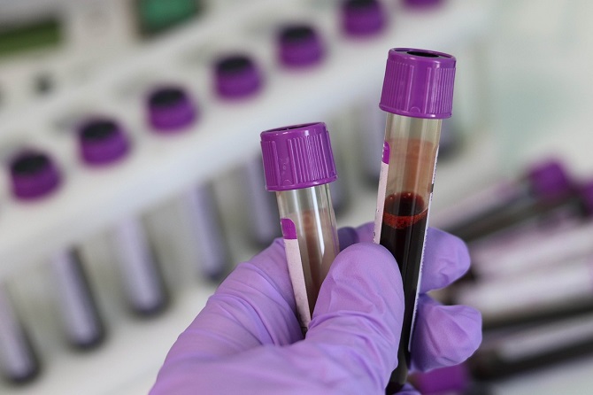 Wissenschaftler haben eine „Vampir“-Methode zur Verjüngung mit Blut entwickelt 1