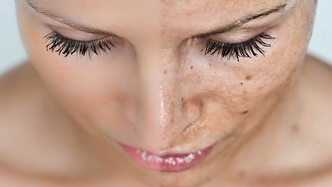 Проблемна шкіра обличчя: причини 2