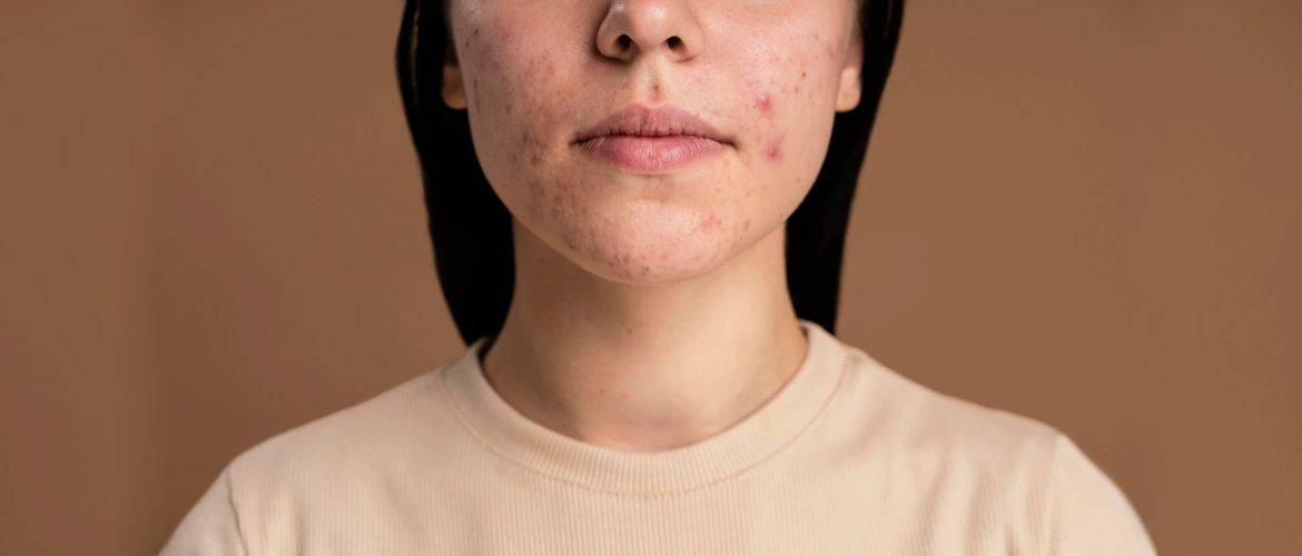 Більше не проблемна: правила догляду за шкірою з недосконалостями