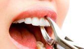 Удаление зубов: Все, что вам нужно знать
