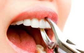 Удаление зубов: Все, что вам нужно знать
