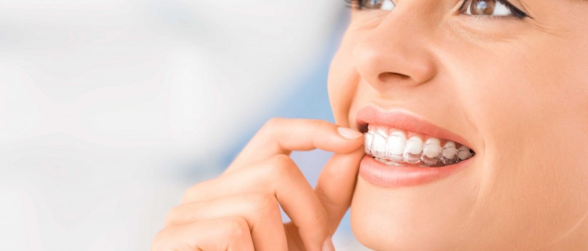Выравнивание зубов элайнерами: что это такое, преимущества и недостатки