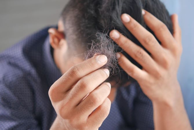 Причины выпадения волос и способы борьбы с алопецией 4
