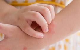 Атопічний дерматит у дитини: чому він з’являється та які його симптоми?