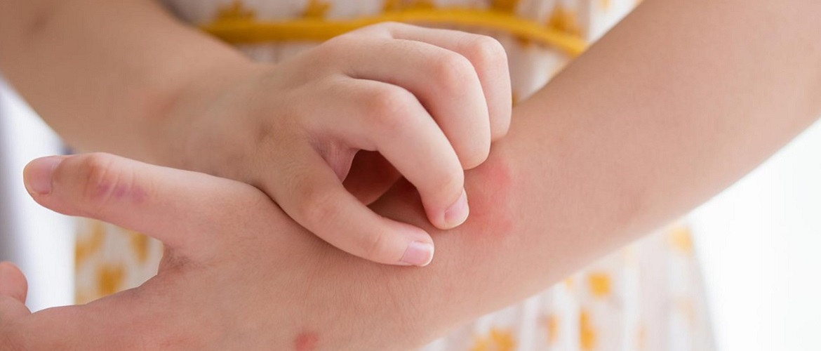 Атопічний дерматит у дитини: чому він з’являється та які його симптоми?