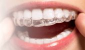 Основні аспекти вирівнювання зубів елайнерами