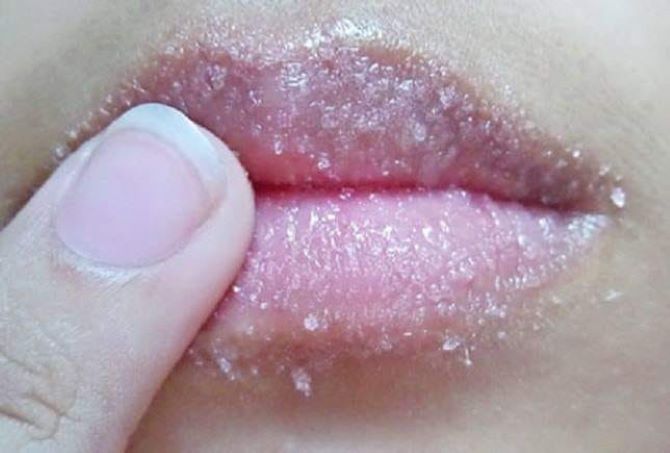 How to avoid chapped lips: causes and treatments 3