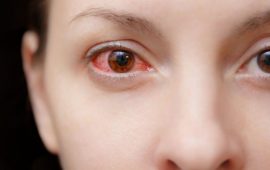 Почервоніння очей: причини та способи лікування