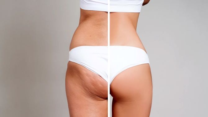 Anti-cellulite wraps at home: effective recipes 1