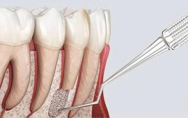 Что такое резекция корня зуба