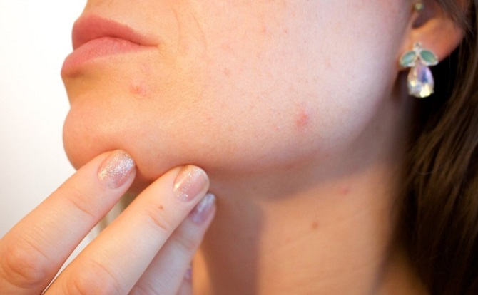 Heat Acne: How to Get Rid of It and Prevent It 1