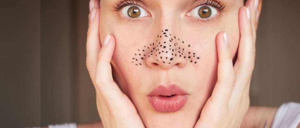 How to get rid of blackheads on the face at home