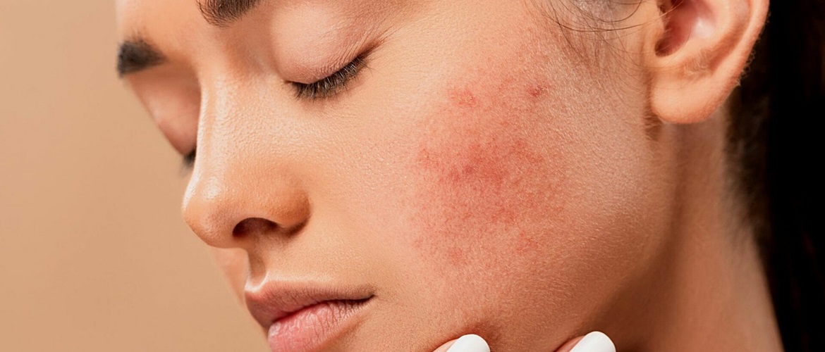 TOP 5 products that cause acne