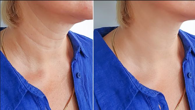 Rings of Venus: how to remove wrinkles on the neck 2