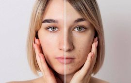 Dull Skin: Causes and How to Prevent It