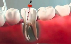 Почему важно своевременно лечить каналы зубов