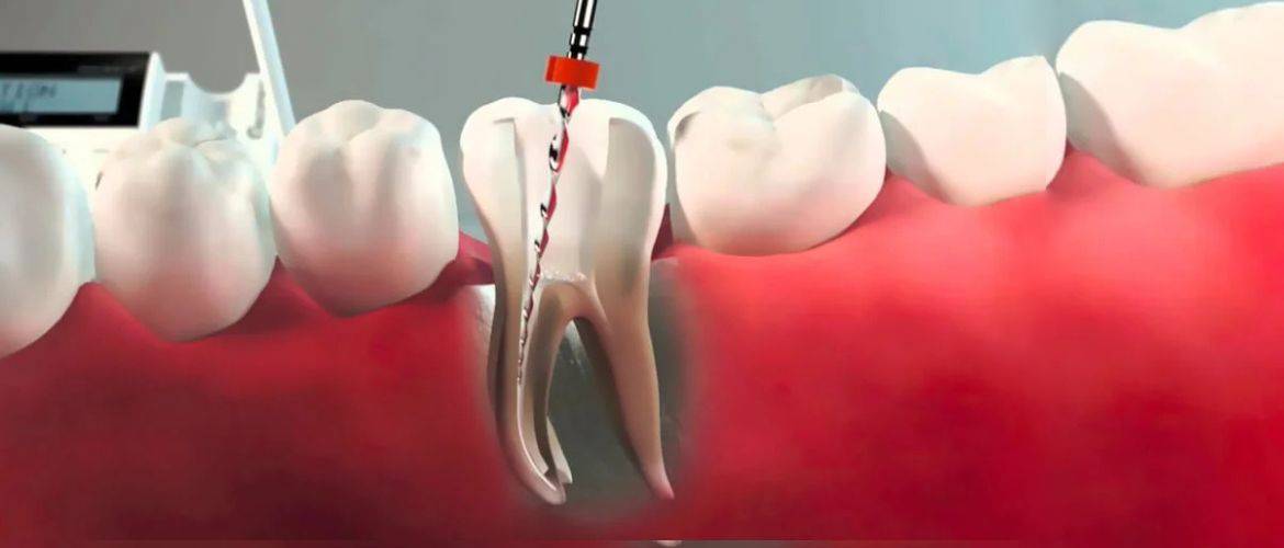 Почему важно своевременно лечить каналы зубов