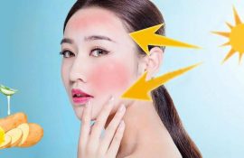 How to Get Rid of Sunburn at Home: 5 Ways