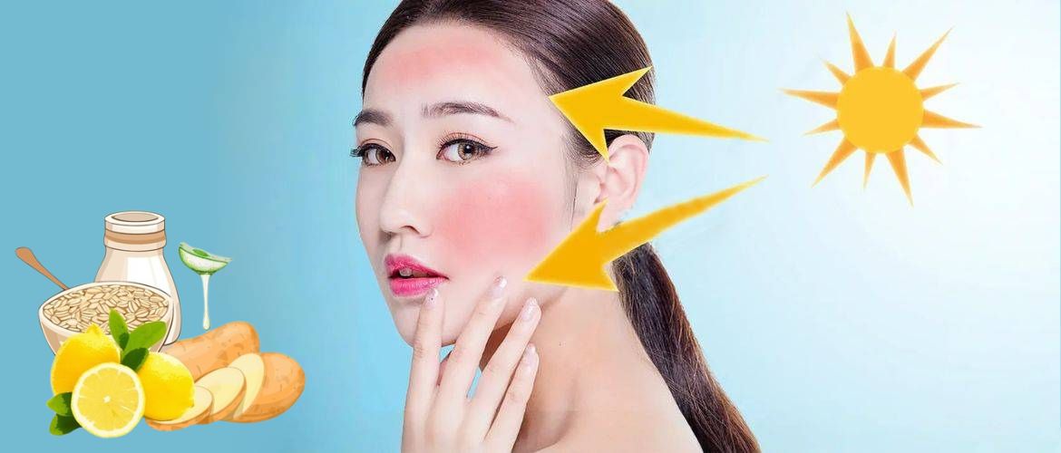 How to Get Rid of Sunburn at Home: 5 Ways