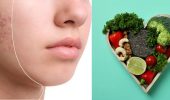 Akne-Diät: Was Sie essen sollten, um hormonelle Akne loszuwerden