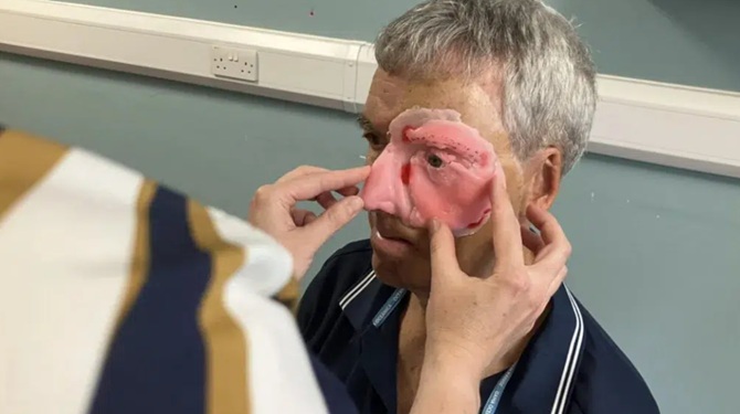 Британець першим у світі отримав лицьовий протез, надрукований на 3D-принтері 1
