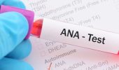 Тест ANA (антинуклеарные антитела): когда и кому назначают анализ, интерпретация результатов