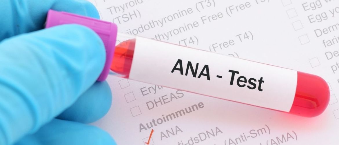 Тест ANA (антинуклеарные антитела): когда и кому назначают анализ, интерпретация результатов
