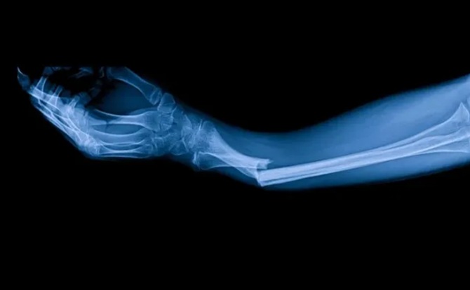 A glue has been created that instantly fuses broken human bones 1