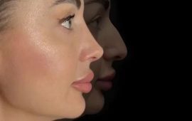 Вторичная ринопластика-исправление неудачных результатов первой операции