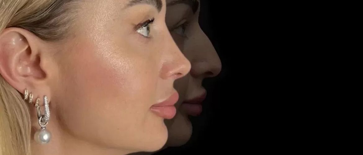 Вторичная ринопластика-исправление неудачных результатов первой операции