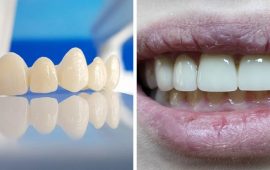 Ціни на цирконієві коронки: що стоїть за цифрами у прайсі