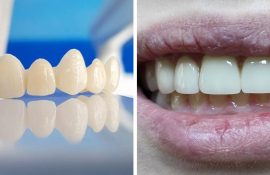 Ціни на цирконієві коронки: що стоїть за цифрами у прайсі