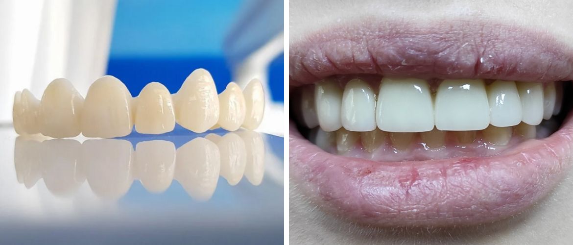 Ціни на цирконієві коронки: що стоїть за цифрами у прайсі