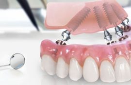 Топ 5 причин выбрать имплант зуба вместо протезирования