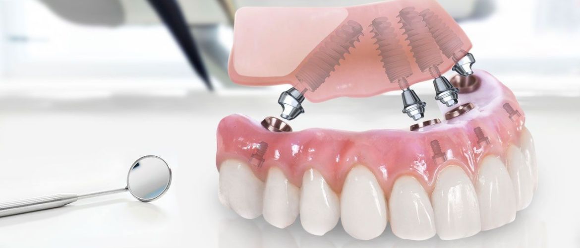 Топ 5 причин выбрать имплант зуба вместо протезирования