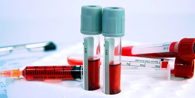 Аналізи крові – коли потрібно проводити лабораторну діагностику та чому вона важлива 1