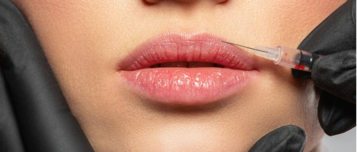 Натуральні губи та сучасна ботулінотерапія: як досягти гармонії без перебільшень