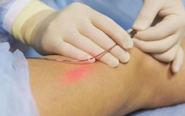 Лазерне видалення вен: як працює сучасна медицина в клініці “Ангіолайт”