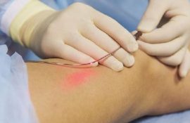 Лазерне видалення вен: як працює сучасна медицина в клініці “Ангіолайт”