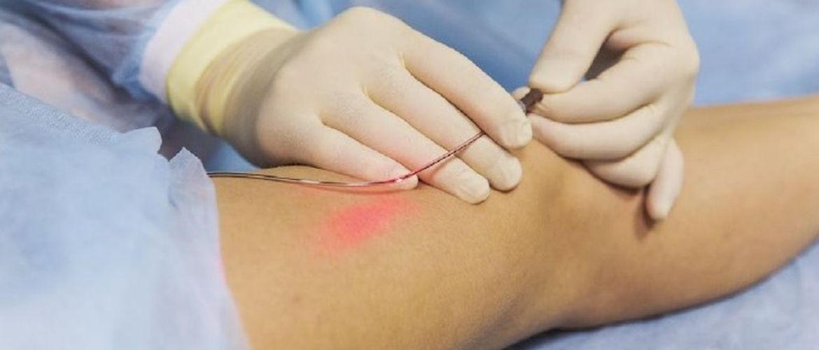 Лазерне видалення вен: як працює сучасна медицина в клініці “Ангіолайт”