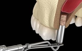 Синус лифтинг: современный взгляд стоматологов