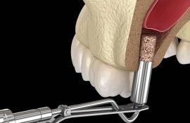 Синус лифтинг: современный взгляд стоматологов