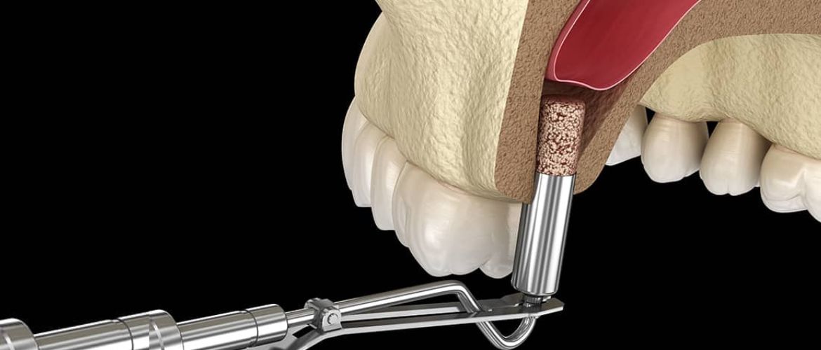 Синус лифтинг: современный взгляд стоматологов