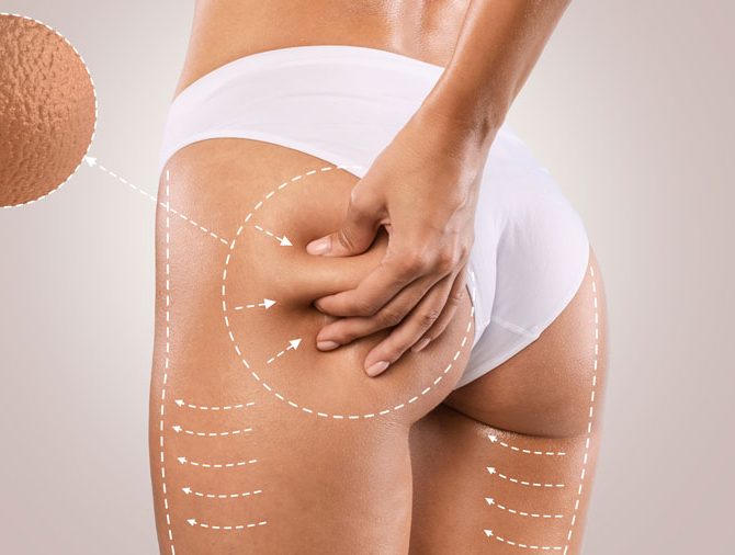 Как убрать целлюлит в домашних условиях 1