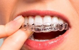 Для чего и в каких случаях ставят капы для зубов